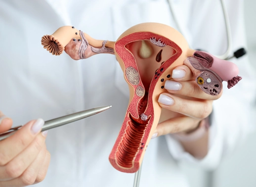 Endometriosis