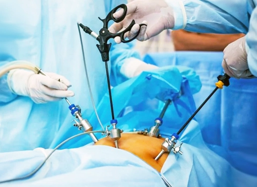 Myomectomy
