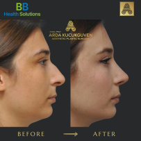 Rhinoplasty