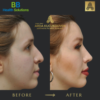 Rhinoplasty