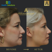 Rhinoplasty