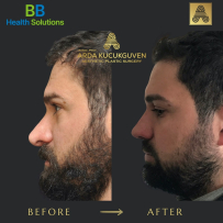 Rhinoplasty