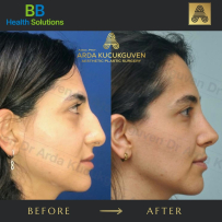 Rhinoplasty