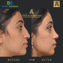 Rhinoplasty