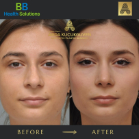 Rhinoplasty