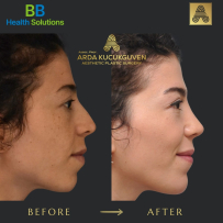 Rhinoplasty