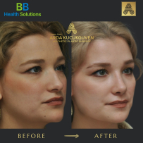 Rhinoplasty