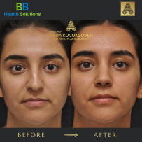 Rhinoplasty