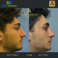 Rhinoplasty