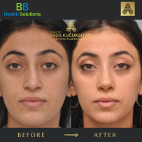 Rhinoplasty