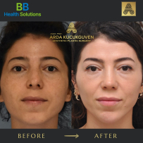 Rhinoplasty