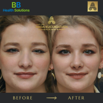 Rhinoplasty