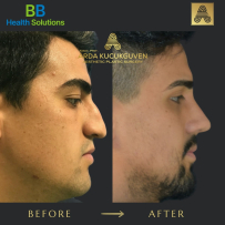 Rhinoplasty