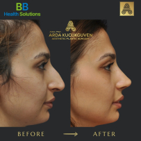 Rhinoplasty