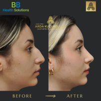 Rhinoplasty