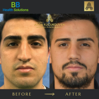 Rhinoplasty