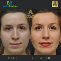 Rhinoplasty