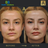Rhinoplasty