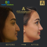Rhinoplasty