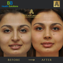 Rhinoplasty