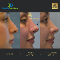 Rhinoplasty