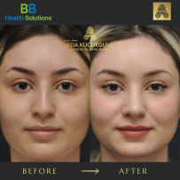 Rhinoplasty