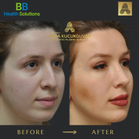 Rhinoplasty