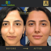 Rhinoplasty
