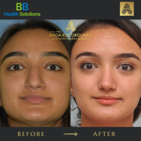 Rhinoplasty