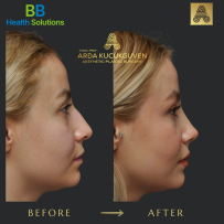 Rhinoplasty