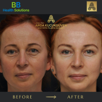Thread Face Lift