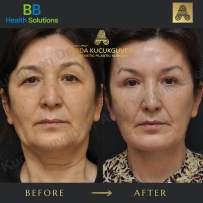 Thread Face Lift