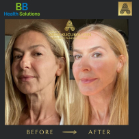 Thread Face Lift