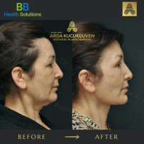 Thread Face Lift