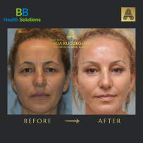 Thread Face Lift