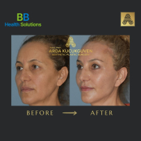 Thread Face Lift