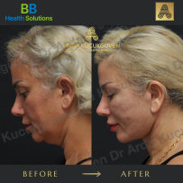 Thread Face Lift