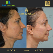 Thread Face Lift
