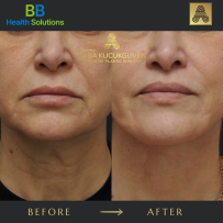 Thread Face Lift