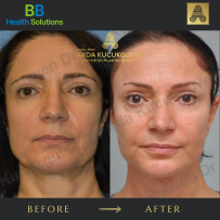 Thread Face Lift